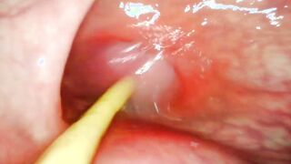 EXTRAORDINARY ANAL INVASION POINT OF VIEW. CAMERA INWARDS HER SPHINCTER AS I PUMMEL HER WITH MY HUGE TROUSER SNAKE AND JIZM DEEP INWARDS